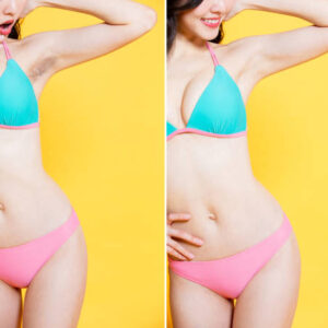 ΑΠΟΤΡΙΧΩΣΗ LASER ALEXANDRITE ΜΠΙΚΙΝΙ, ΜΑΣΧΑΛΕΣ